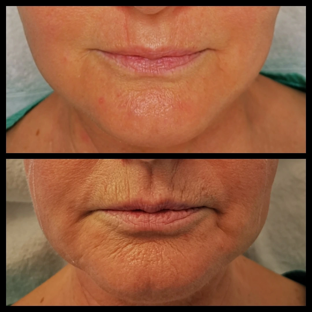 Hautbild im Bereich von Lippen und Kinn