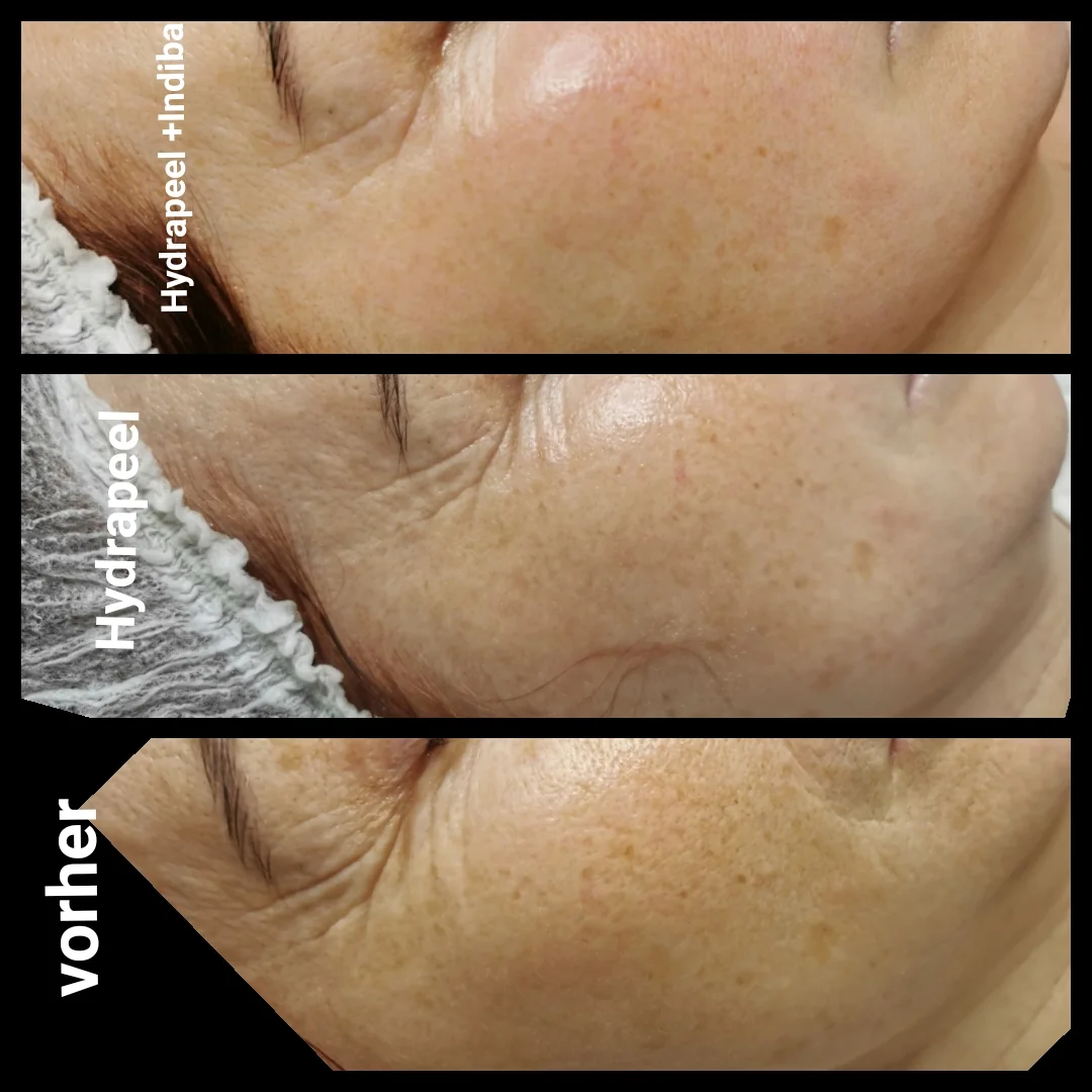 Hautbild vor und nach Hydrapeel plus INDIBA