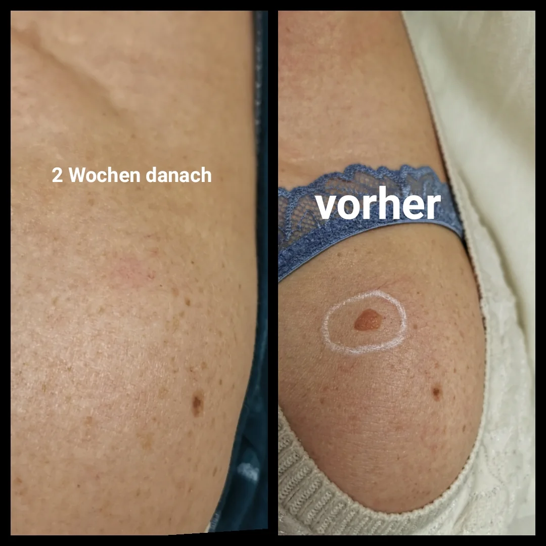 Onetec-Ergebnis an einer Hautstelle