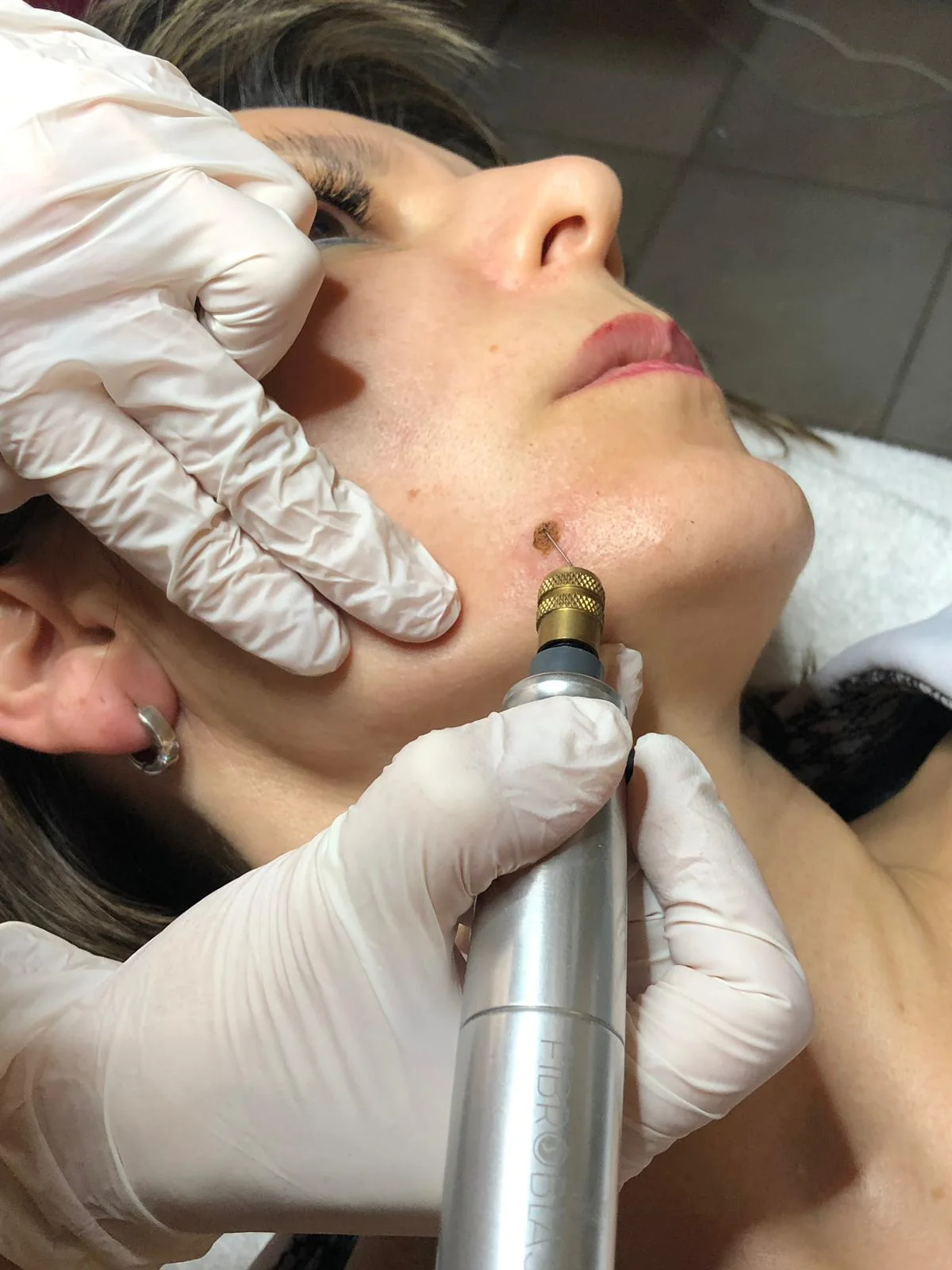 Fibroblast Plasma-Lifting-Behandlung
