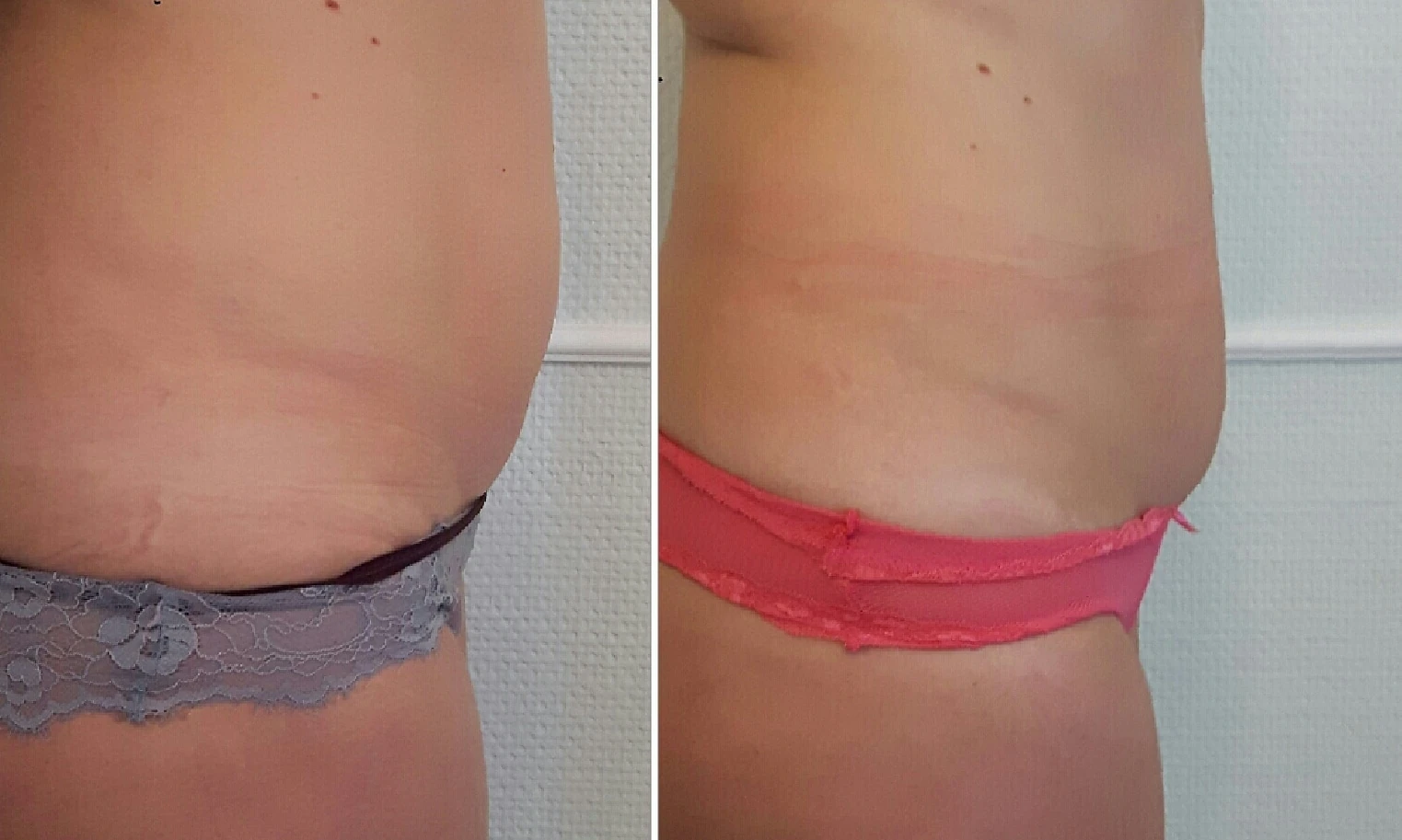 Seitenansicht des Bauchbereichs im Vergleich