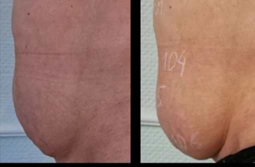 Vergleichsansichten des Bauchbereichs im Behandlungsverlauf