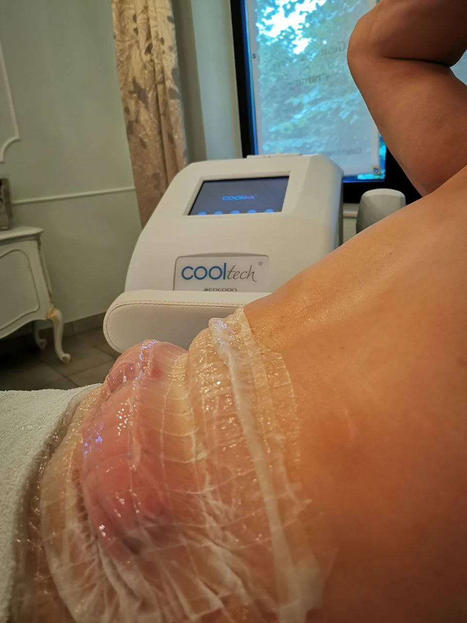 Cooltech-Gerät und Applikator bei der Kryolipolyse
