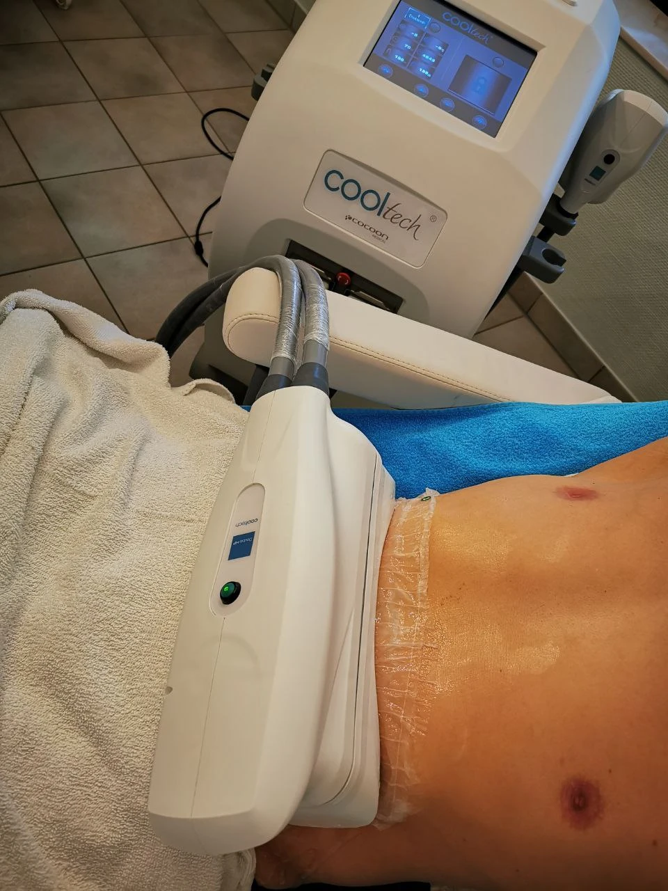 Cooltech-Applikator während der Kryolipolyse-Anwendung
