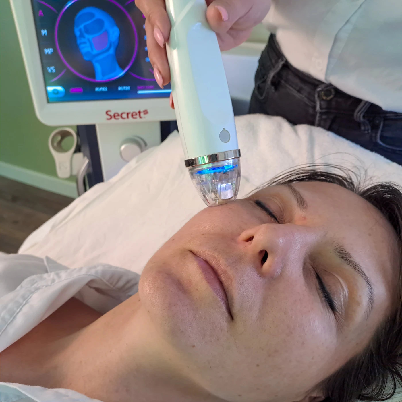 Microneedling-RF-Behandlung